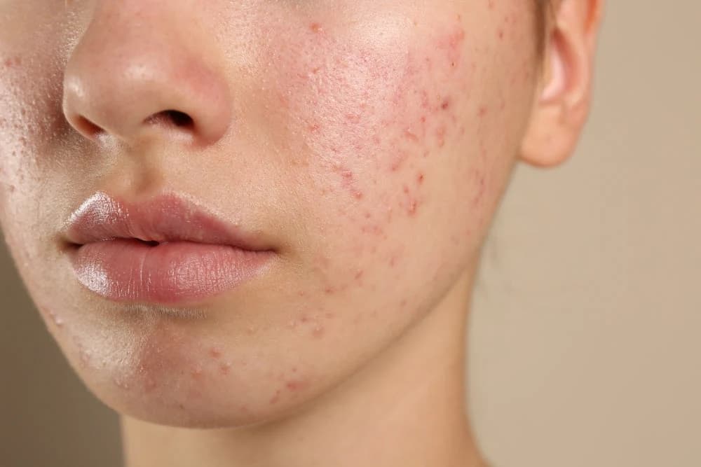Barrier skincare